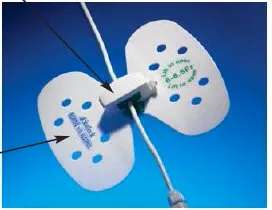 Bard Stabilization Device StatLock - M-512998-1640 | Box of 25